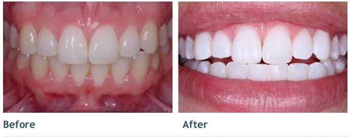 Up-close photo of a mouth before and after teeth whitening